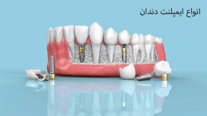انواع-ایمپلنت-دندان1