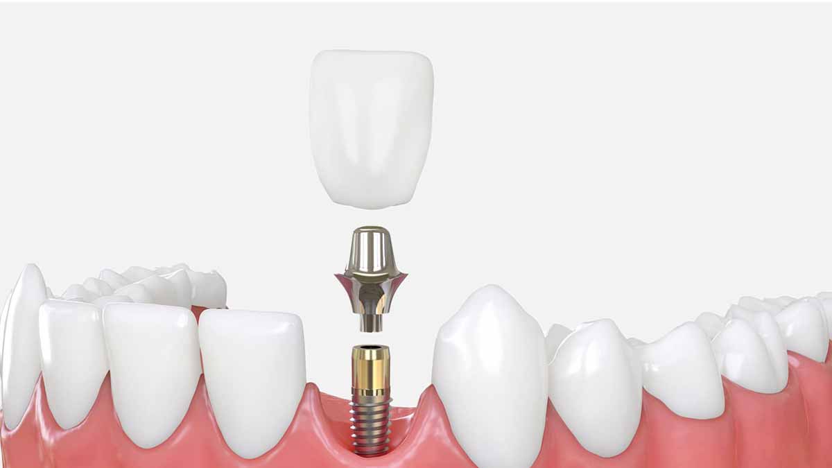انواع-ایمپلنت-دندان2