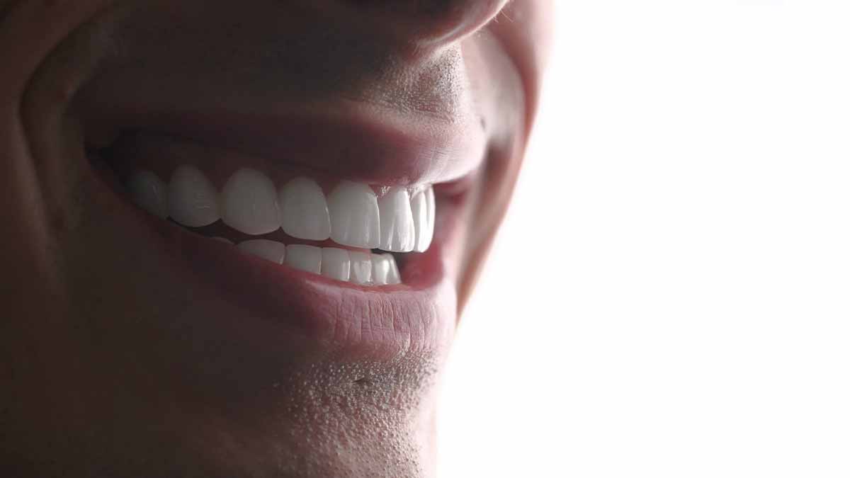 خودداری از ساییدن لمینت‌ها به دندان‌های مقابل آن